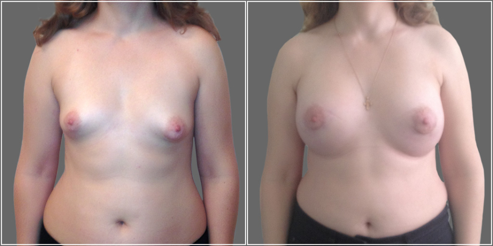 Асимметрия груди