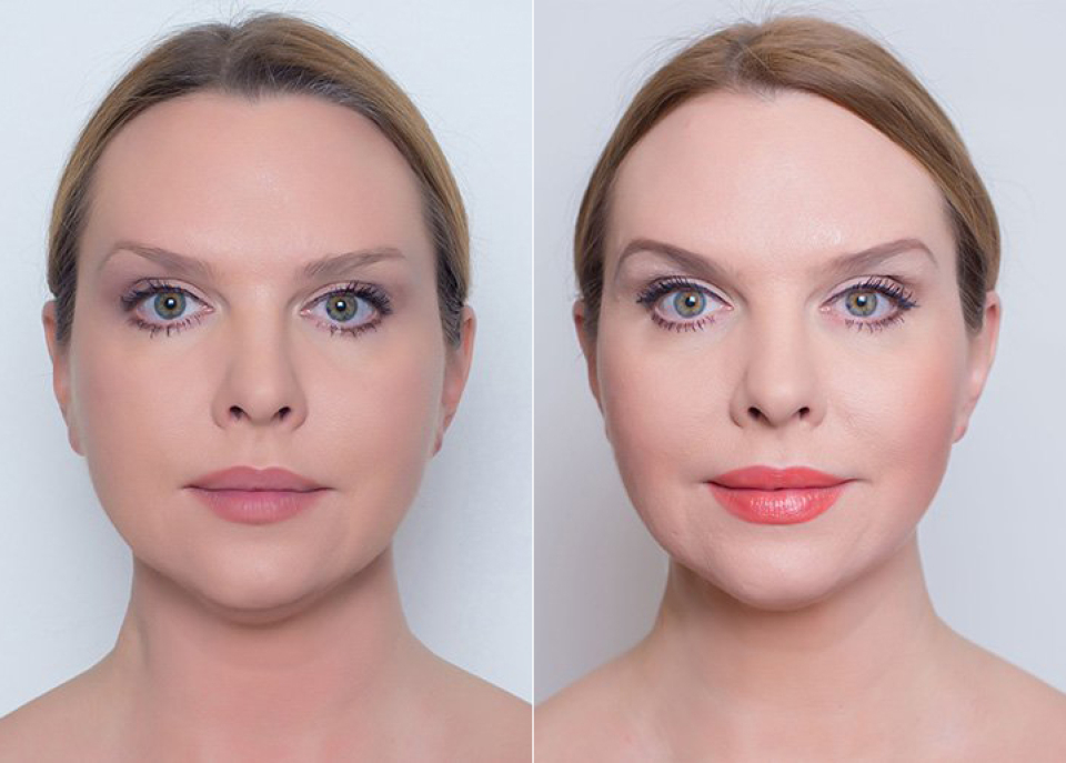 Певица Варвара до и после ультразвукового СМАС-лифтинга