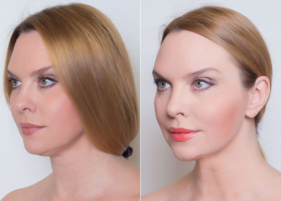 Певица Варвара до и после ультразвукового СМАС-лифтинга