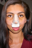 Пластика носа неизбежно влечет появление синяков