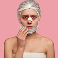 Синяки после ринопластики