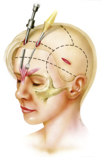 Подтяжка лица