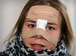 Ринопластика после травмы носа