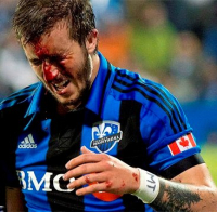 Лечение спортивных травм при помощи ринопластики