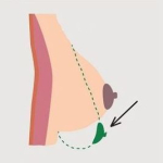 Подтяжка груди: от чего зависит выбор места разрезов?