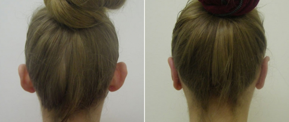 Отопластика Залина Елоева