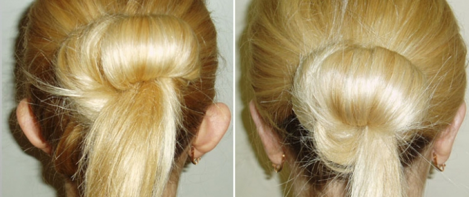 Отопластика Залина Елоева