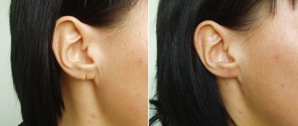 Разорванная мочка уха