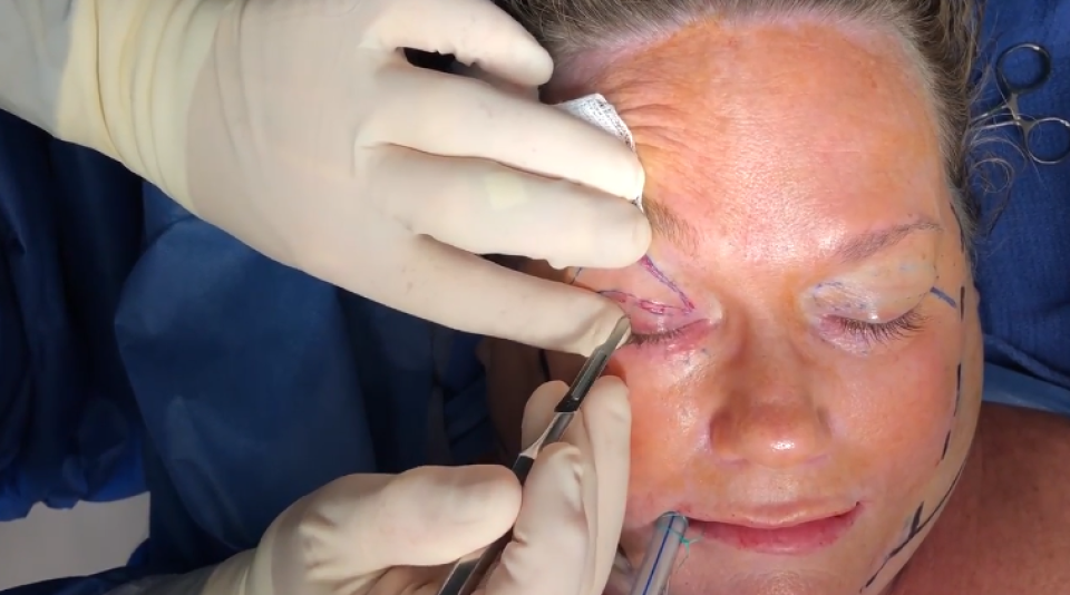 Как проводится блефаропластика