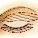 Возможные осложнения после блефаропластики