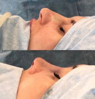 Ринопластика у доктора Павла Куприна