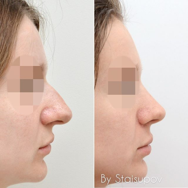 Закрытая ринопластика