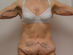 Торсопластика