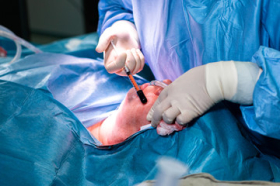 Липофилинг лица