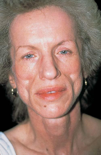 Почему возникает липодистрофия?