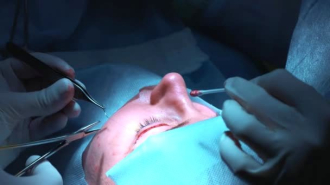 Сколько стоит пластика век в России?