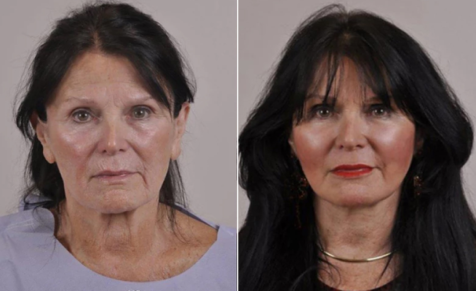 Липофилинг лица