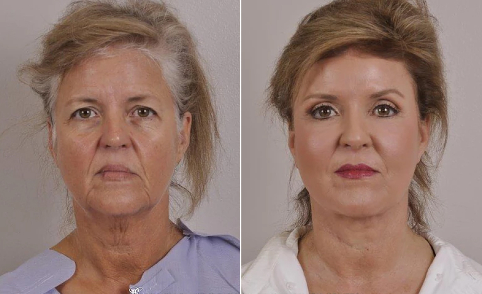 Липофилинг лица