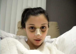 Уход за швами и кожей при ринопластике носа