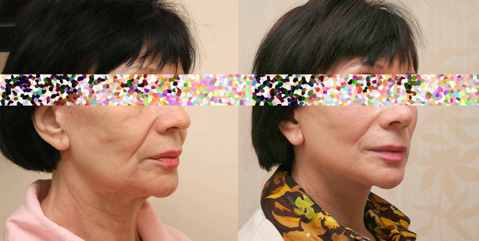 Пациентка доктора Александра Жукова до и после комплексной операции по подтяжке лица и шеи