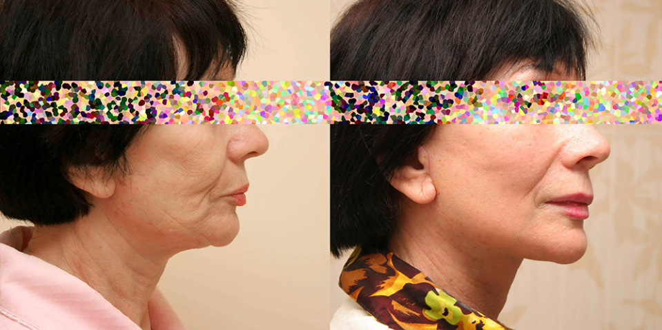 Пациентка доктора Александра Жукова до и после комплексной операции по подтяжке лица и шеи