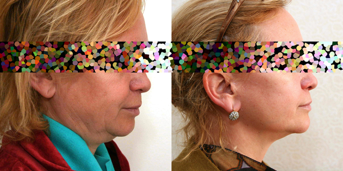 Пациентка доктора А. Жукова до и после подтяжки лица