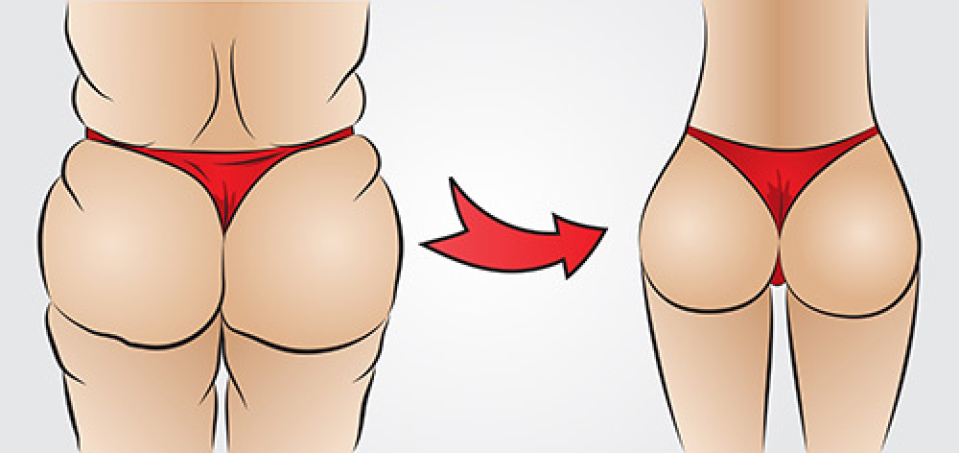 Липофилинг как малоинвазивное теломоделирование