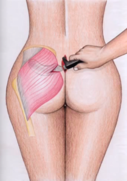 Глютеопластика