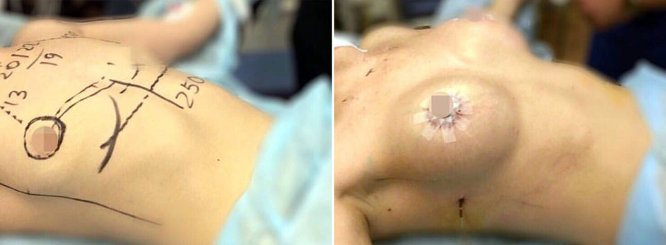 Рустем Каримов увеличение груди