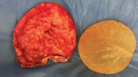 Капсулярная контрактура