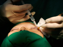 Хирургические моменты блефаропластики