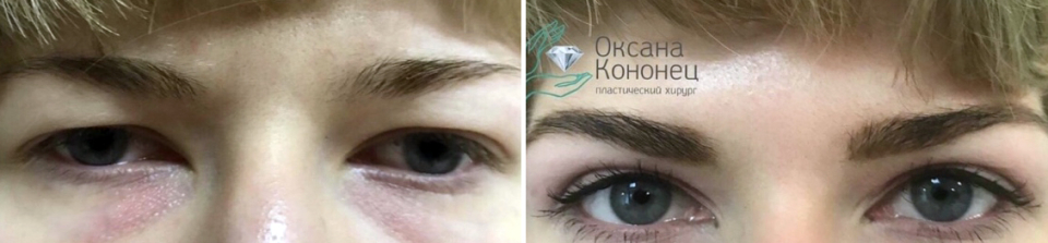 Блефаропластика Оксана Кононец