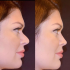 Юлия Рыбакова  до и после ринопластики