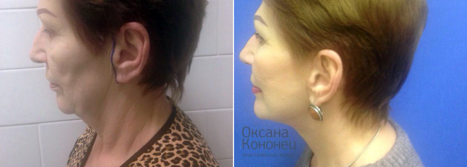 Подтяжка шеи Оксана Кононец