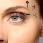 Блефаропластика - самая популярная операция в России