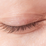 Патологии век: блефаропластика как решение