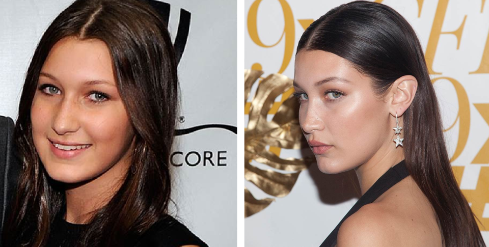 Белла Хадид и ринопластика