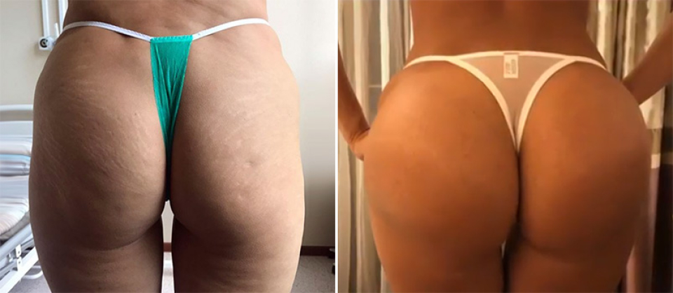 Глютеопластика Дмитрий Крысин