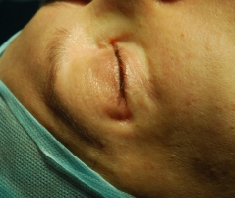 Пациентка после проведенной операции