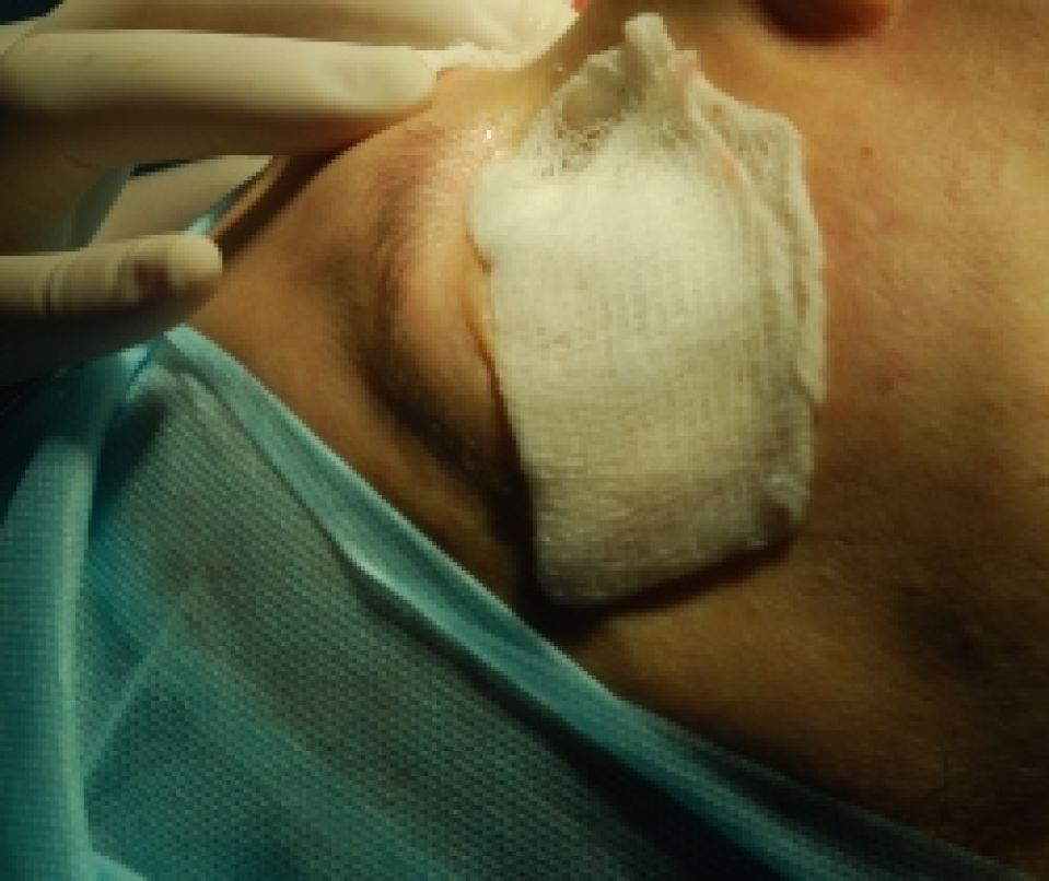 Влажная повязка с антибактериальным раствором