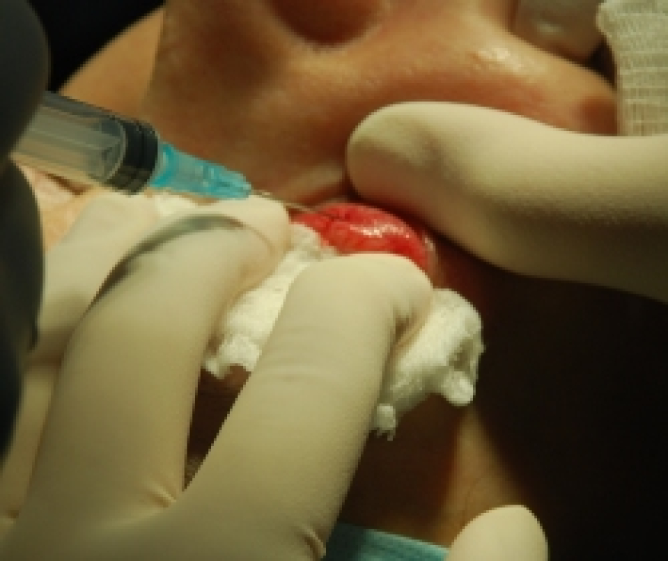 Гидропрепаровка нижнего века с целью отделения круговой мышцы нижнего века от теноновой связки