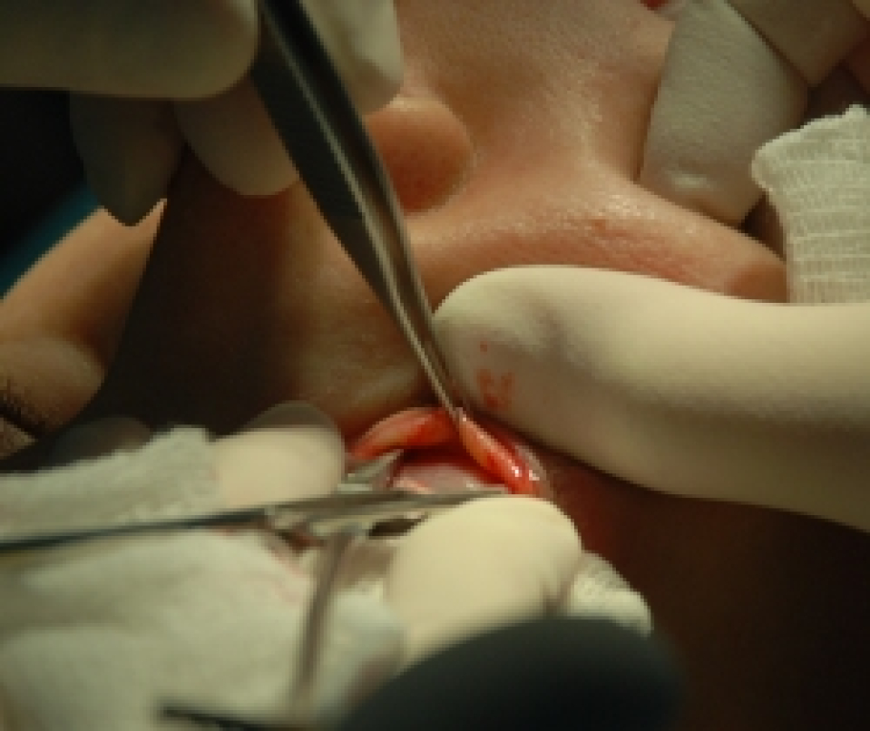 Внутренний разрез конъюктивы, отслойка круговой мышцы нижнего века от теноновой связки