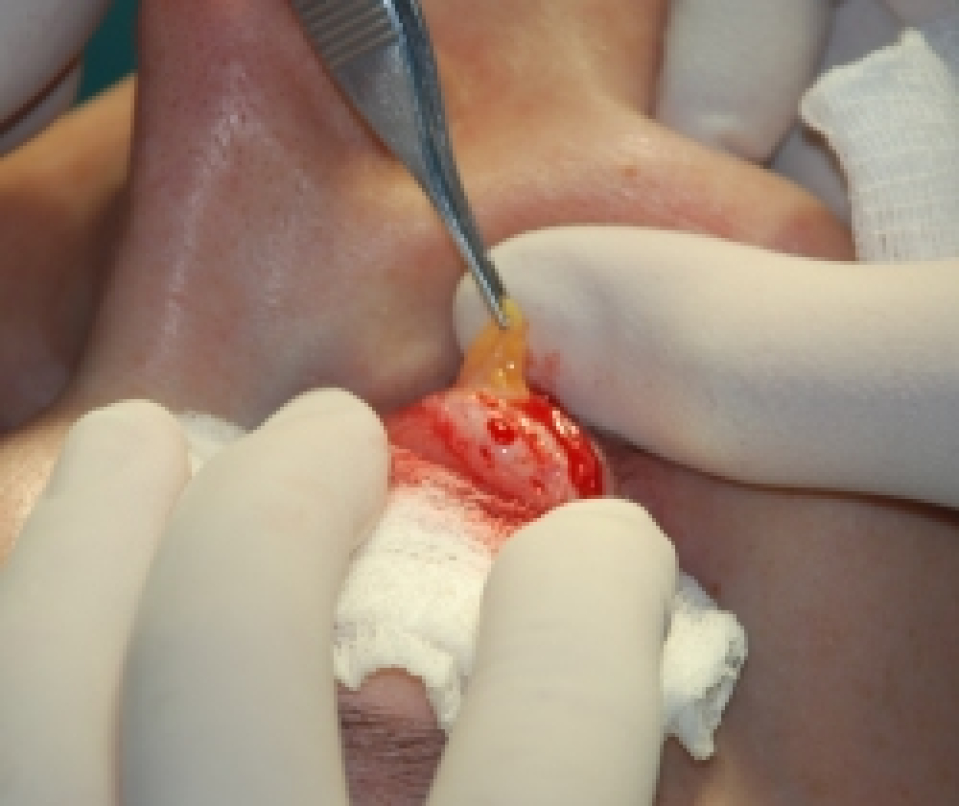 В местах выбухания внутренней, срединной и наружной грыжи нижнего века сделаны проколы в теноновой связке с выделением грыж в данных областях