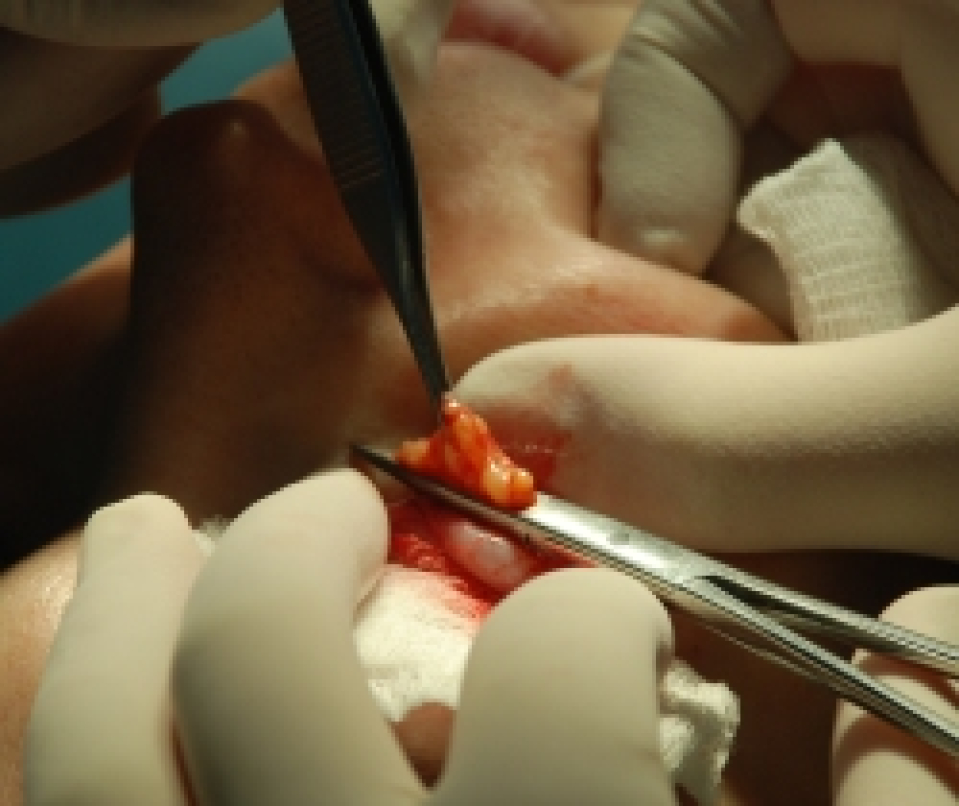 Удаление внутренней грыжи нижнего века