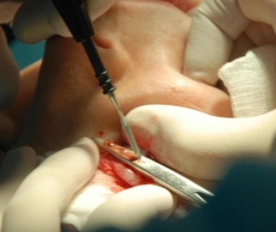 Коагуляция капилляров грыжевых мешков