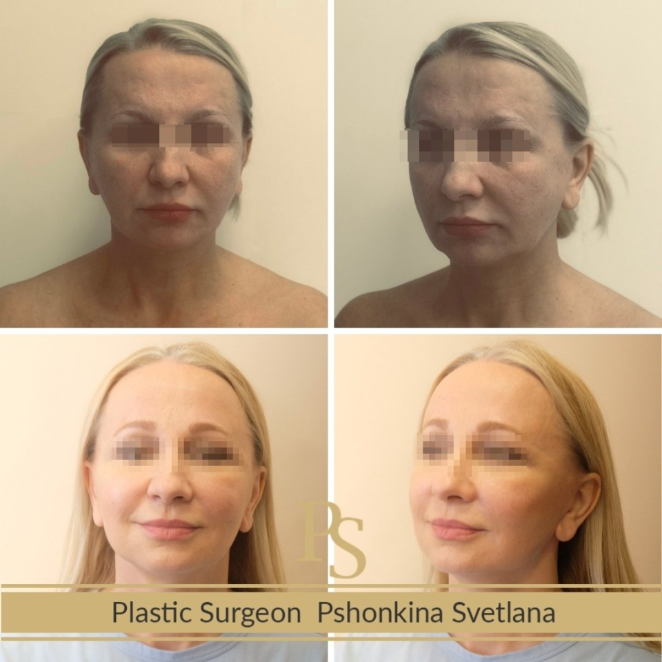 Фото до и после СМАС и эндолифтинга у доктора Пшонкиной С.Ю.