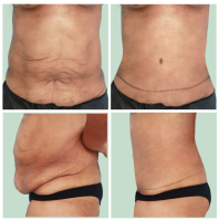 Пример результатов бодилифтинга