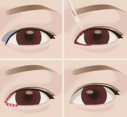 Эпикантопластика