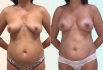 увеличение груди