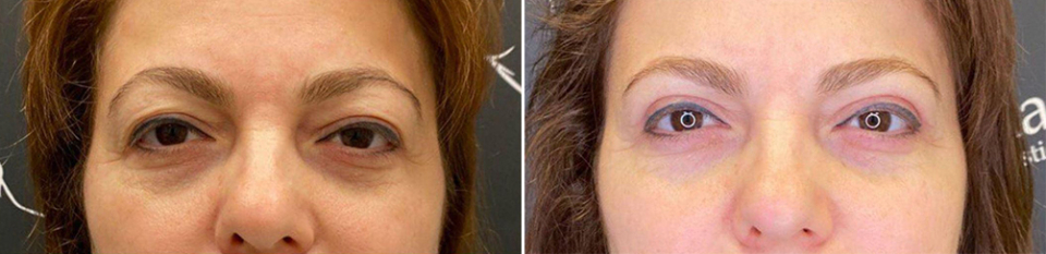 Фото пациентки до и после пластики век у доктора Пайтяна